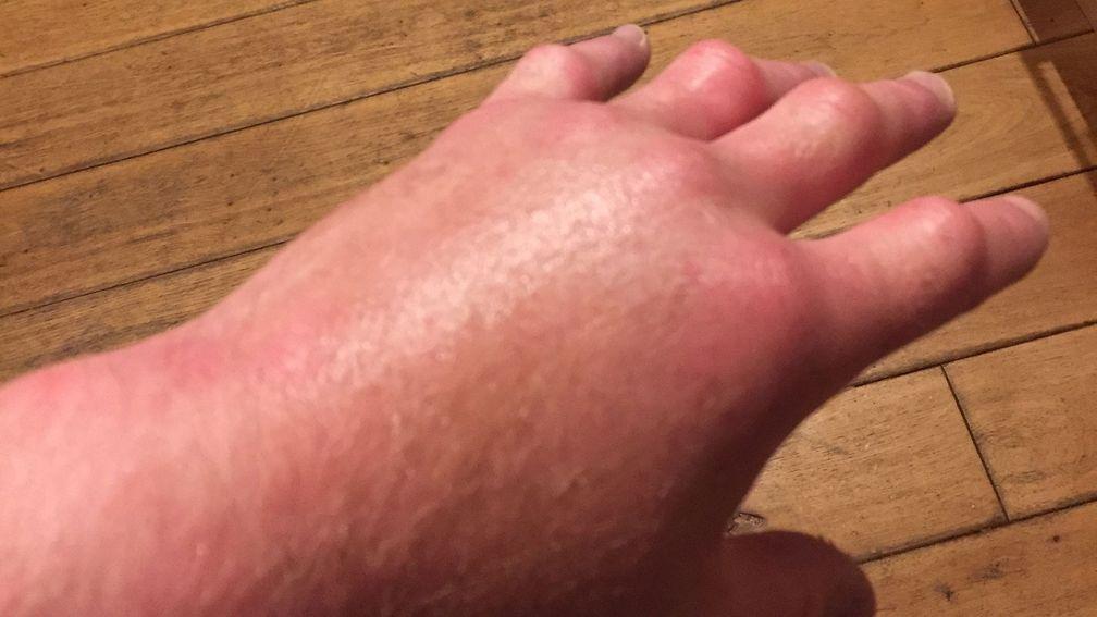 Paul Hanagan: hand is swollen 'like a mini football'