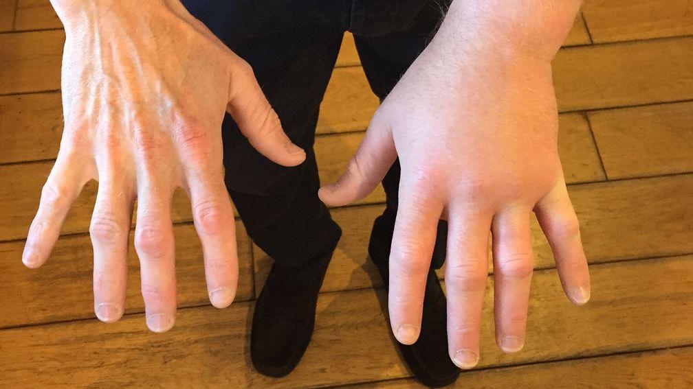 Paul Hanagan shows the severe swelling in his left hand