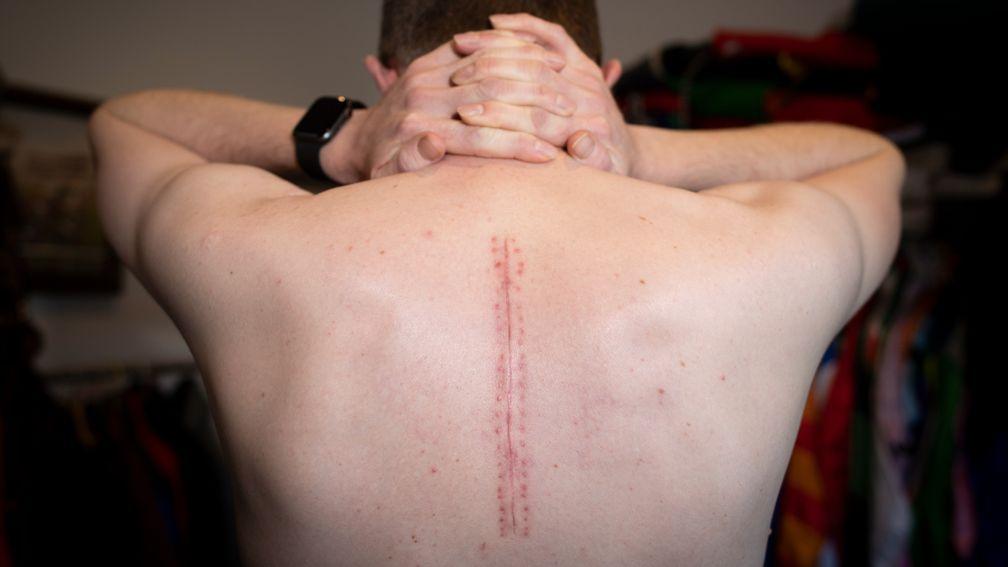 Josh Moore's scar after surgery on his back